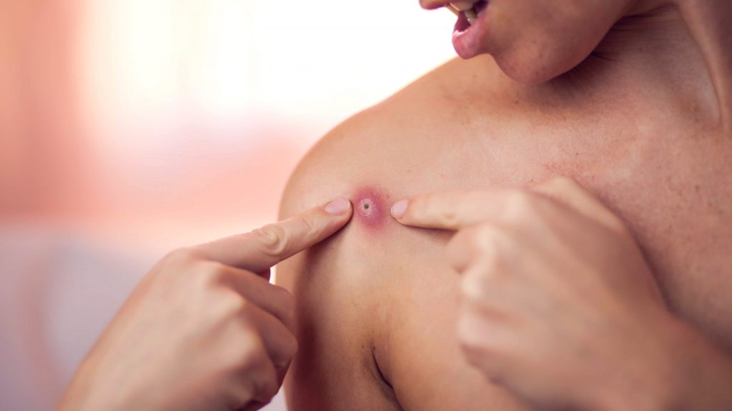 pommade pour furoncle sans ordonnance
